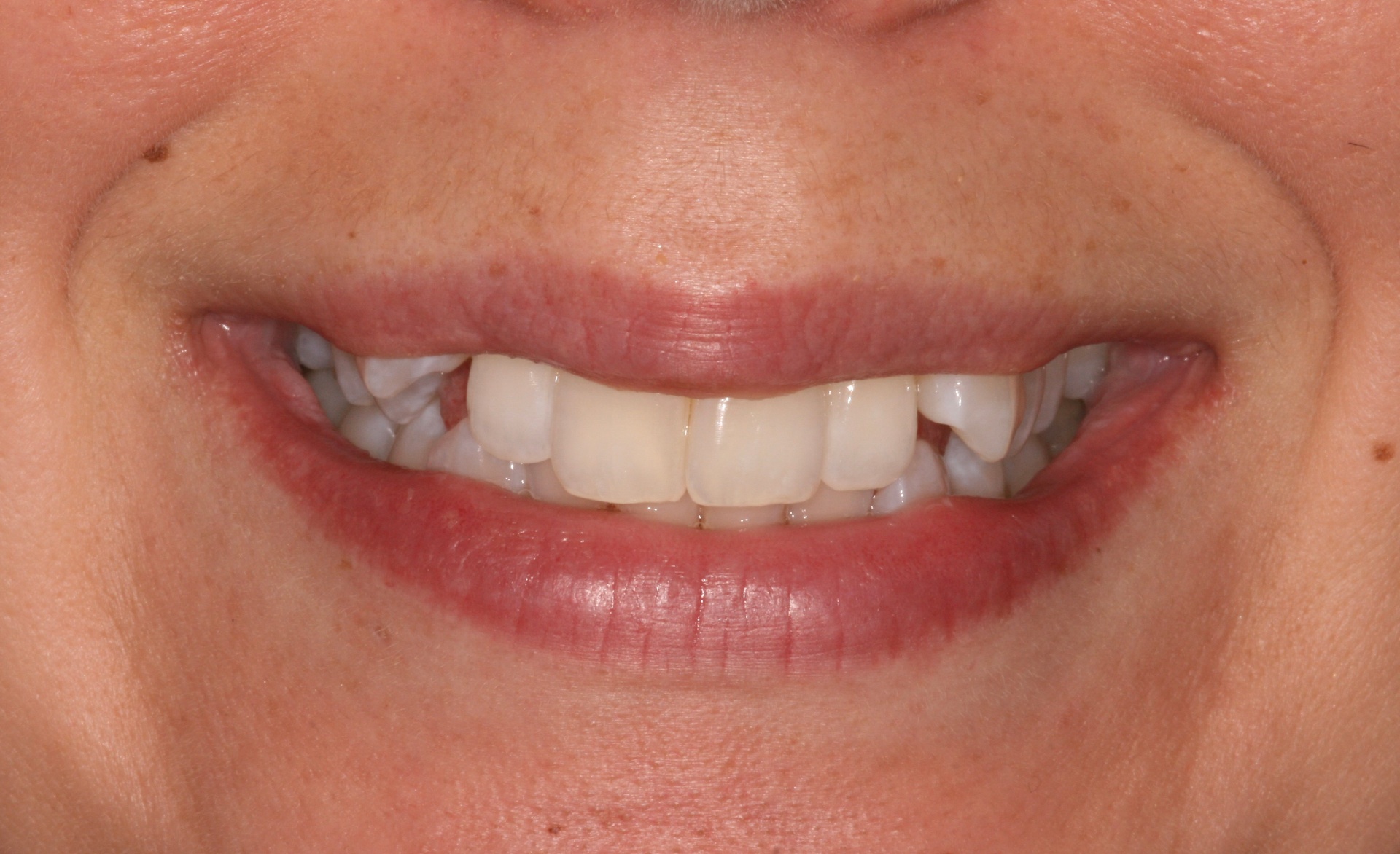 Aesthetic tooth alignment with clear aligner treatment (14 months treatment time). — before treatment at Smithfield Dental