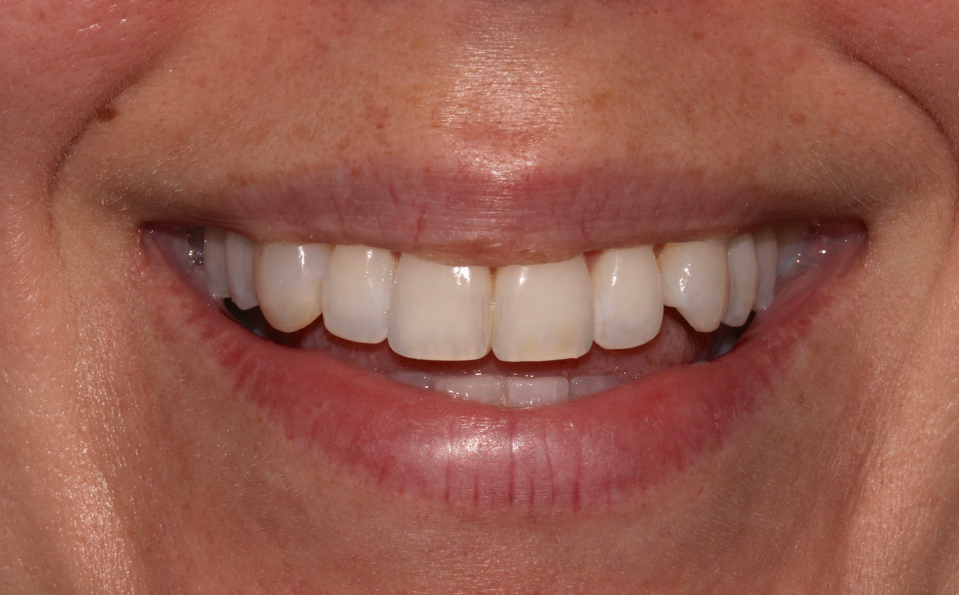 Aesthetic tooth alignment with clear aligner treatment (14 months treatment time). — after treatment at Smithfield Dental