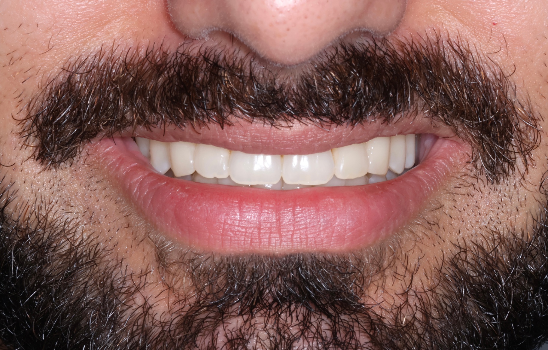 Clear aligner treatment to align the teeth, broaden the smile, improve occlusion and create smile harmony (18 months treatment time). — after treatment at Smithfield Dental