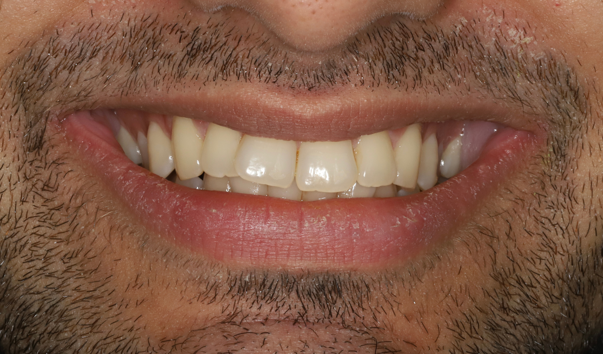 Clear aligner treatment to align the teeth, broaden the smile, improve occlusion and create smile harmony (18 months treatment time). — before treatment at Smithfield Dental
